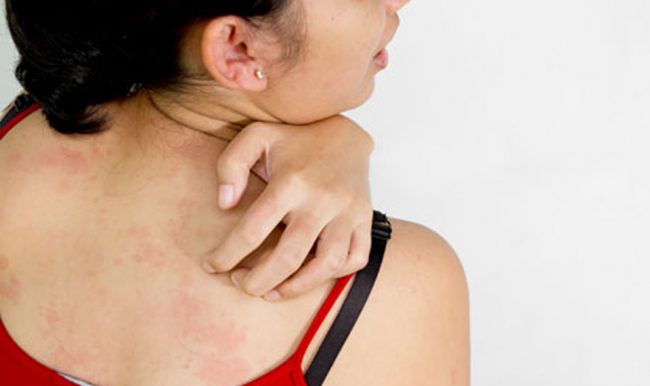 dermatitis lečenje dermatitisa