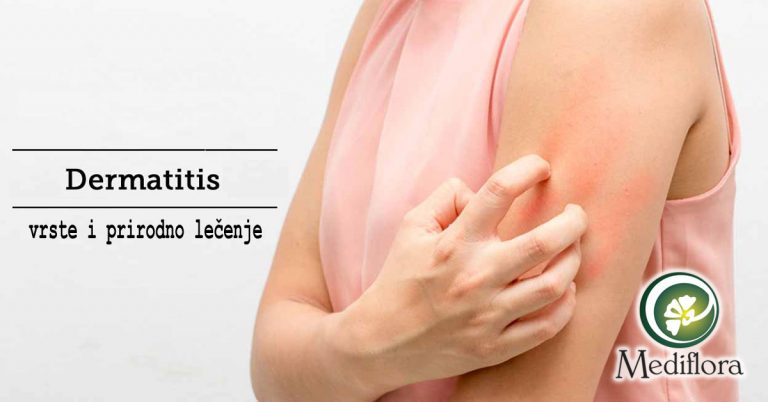 dermatitis-vrste-i-prirodno-lecenje dermatitis vrste i prirodno lečenje