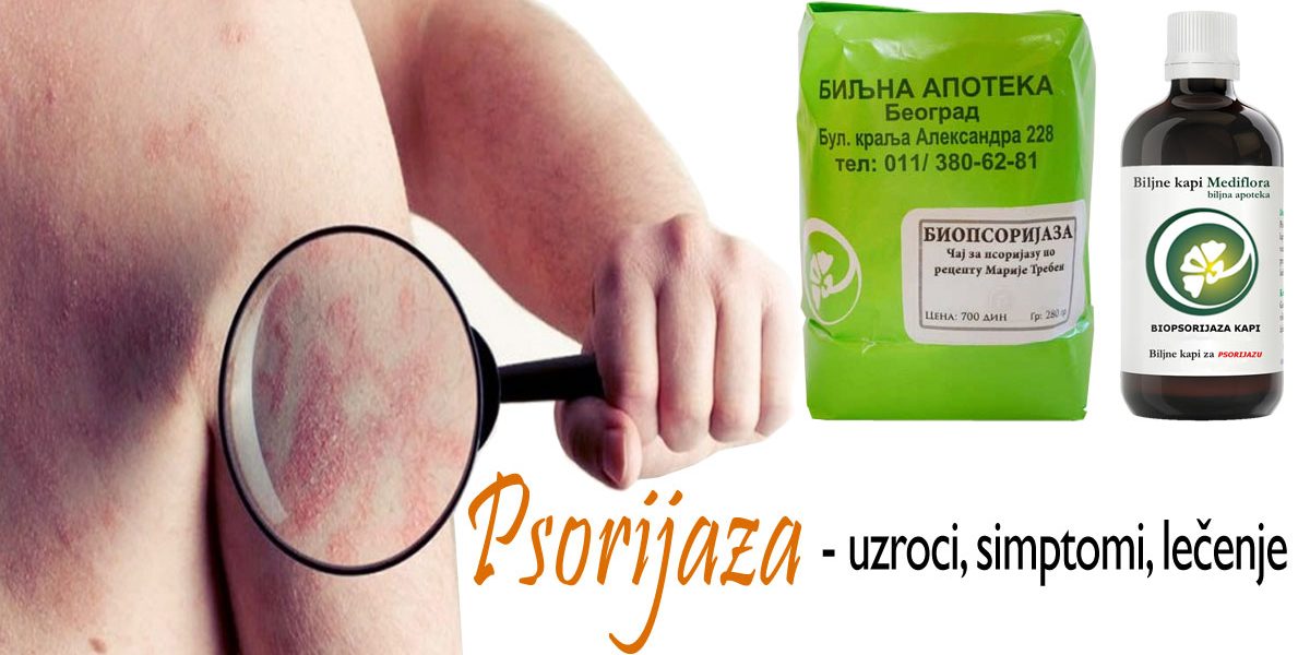 psorijaza Psorijaza - uzroci, simptomi, lečenje