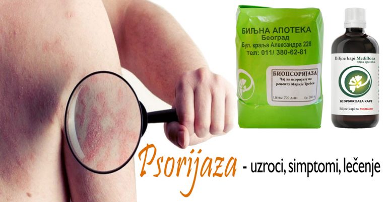 psorijaza Psorijaza - uzroci, simptomi, lečenje
