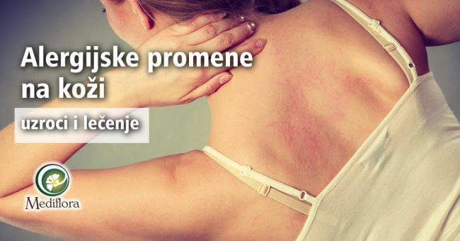 Alergijske promene na koži - uzroci i lečenje