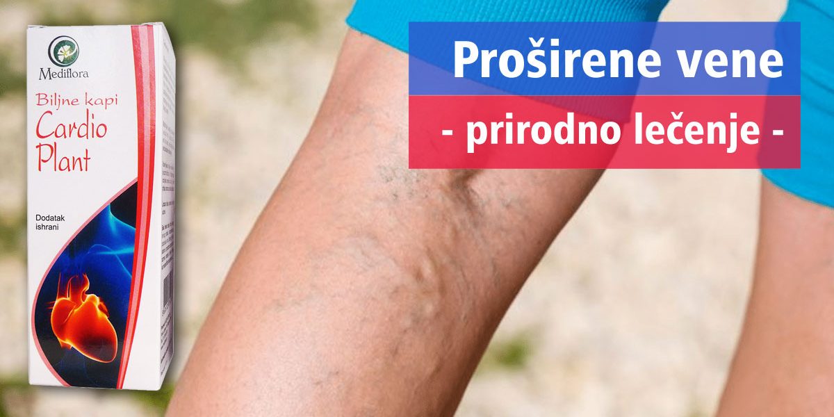 Proširene vene – prirodno lečenje