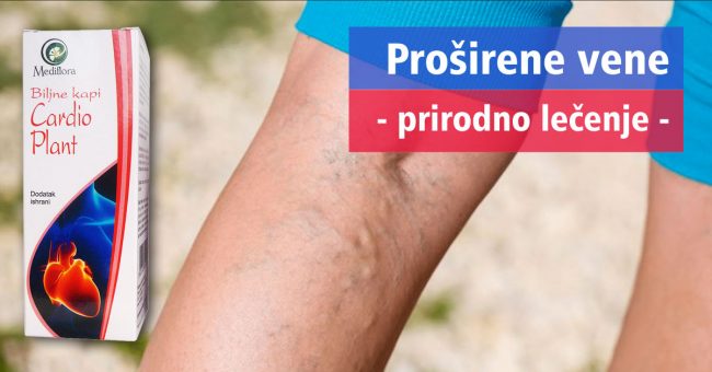 Proširene-vene Proširene vene – prirodno lečenje