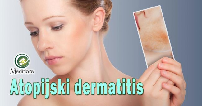 Atopijski-dermatitis—šta-pogoršava-ovo-stanje-kože