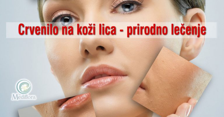 Crvenilo-na-koži-lica—prirodno-lecenje Crvenilo na koži lica - prirodno lečenje
