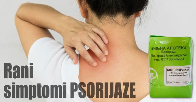 Rani-simptomi-psorijaze Rani simptomi psorijaze