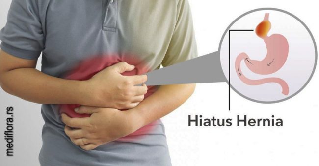 Hiatus-Hernija Hijatus hernija