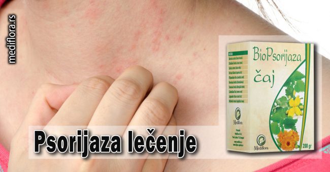 Psorijaza lečenje