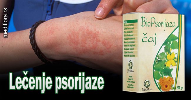 Lečenje psorijaze