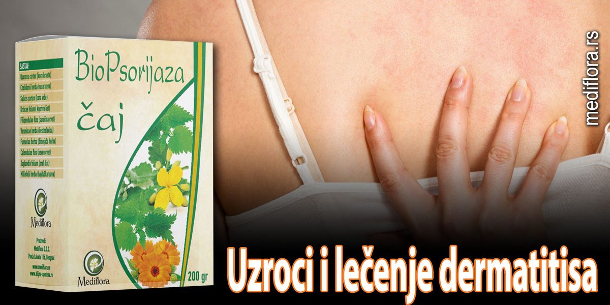 lečenje dermatitisa