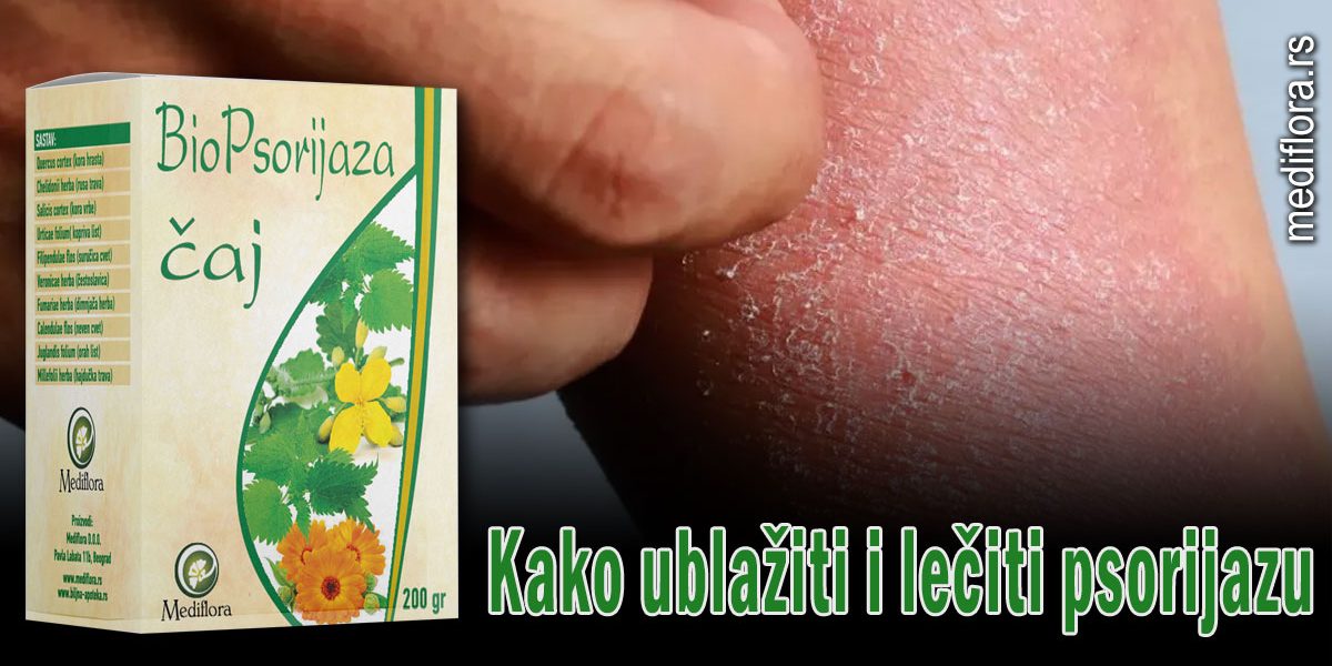 Kako ublažiti i lečiti psorijazu