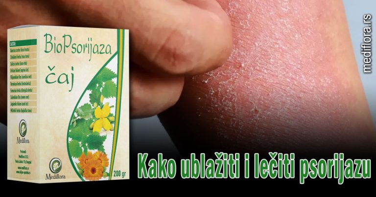 Kako-ublažiti-i-lečiti-psorijazu Kako ublažiti i lečiti psorijazu